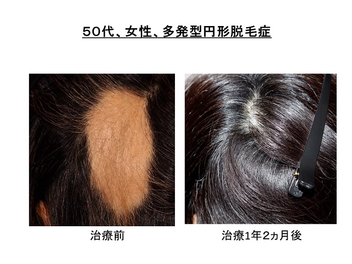 円形脱毛症　病院